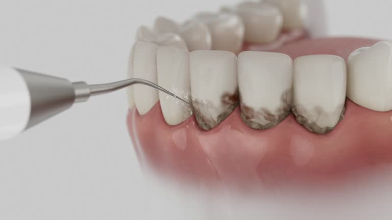 Trusted Wisdom Tooth Removal service in Cascades, VA - Dentist Open Now